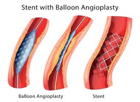stent-with-balloon-angioplasty-image