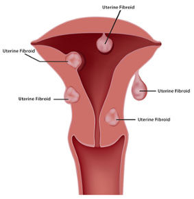 uterine fibroids illustration image