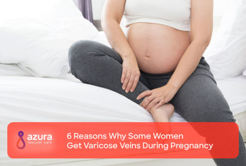 6 reasons why some women get varicose veins during pregnancy main image