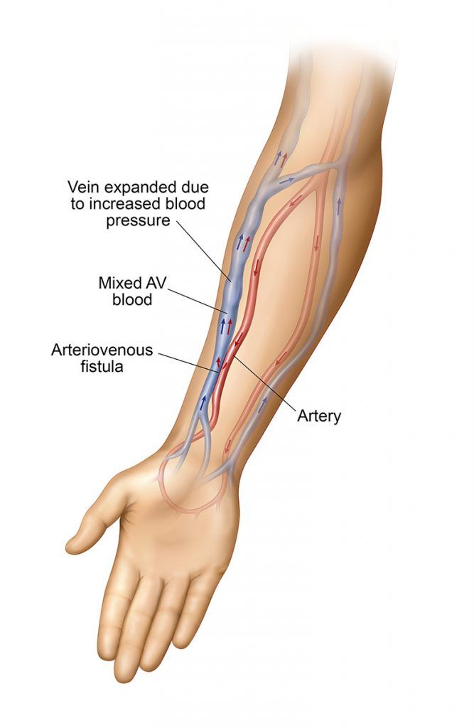 An illustration of an arm with veins and arteries