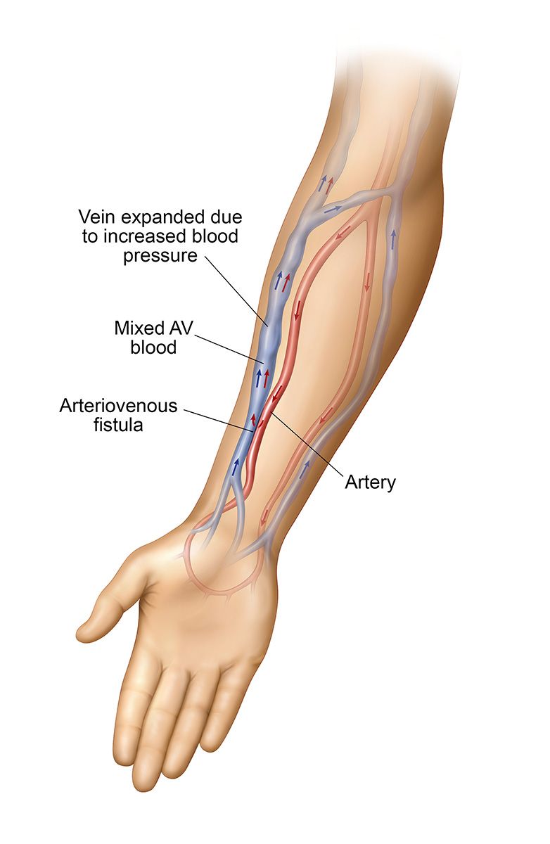 Arteriovenous Fistula Illustration