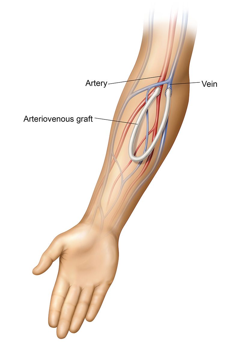 Arteriovenous Graft Illustration