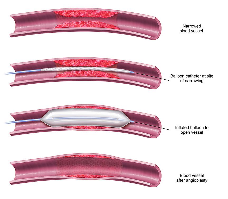 Angioplasty Procedure Illustration