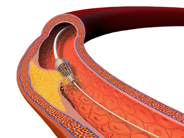 Atherectomy illustration