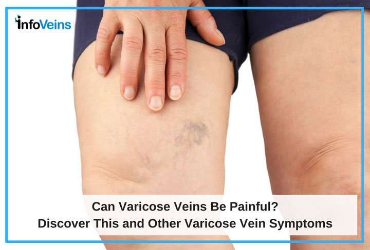 Can Varicose Veins Be Painful? Discover This and Other Varicose Vein Symptoms