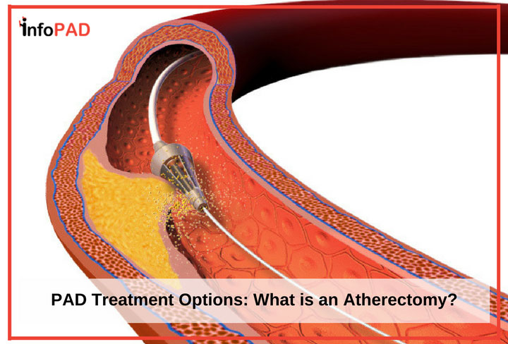 PAD Treatment Options - What is an Atherectomy Feature Image