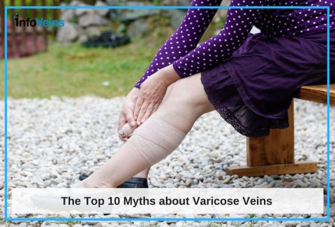 What Exactly Are Varicose Veins? The Top 10 Myths About Varicose Veins