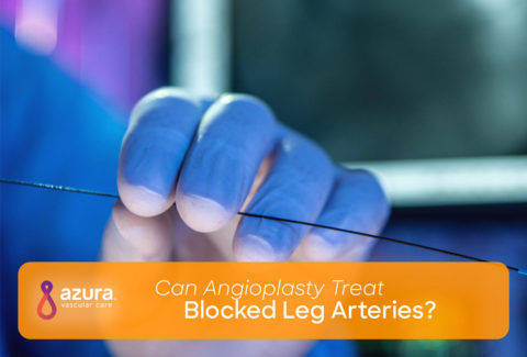Can Angioplasty Treat Blocked Leg Arteries main image
