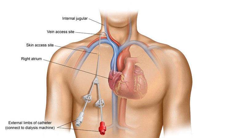 Central Venous Catheter Illustration
