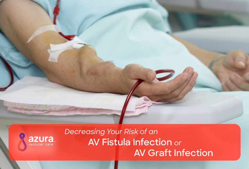 Decreasing Your Risk of an AV Fistula Infection or AV Graft Infection main image