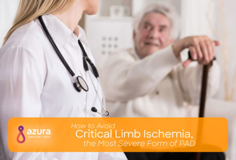 How to Avoid Critical Limb Ischemia, the Most Severe Form of PAD main image