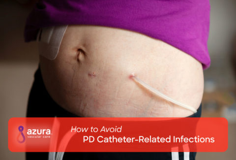 How to Avoid PD Catheter-Related Infections main image