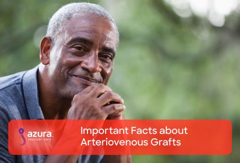 Important Facts about Arteriovenous Grafts Feature Image