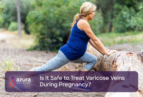 Is It Safe to Treat Varicose Veins During Pregnancy main image