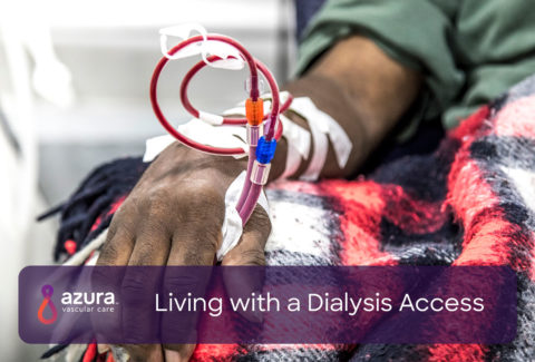 Living with a Dialysis Access main image