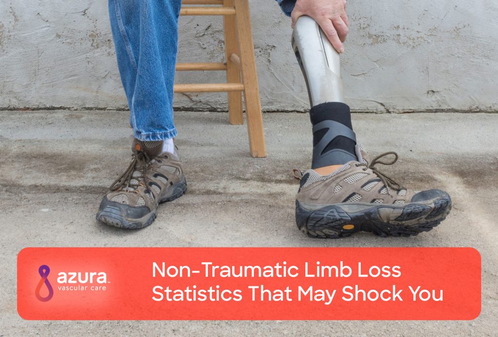 Non-Traumatic Limb Loss Statistics That May Shock You main image