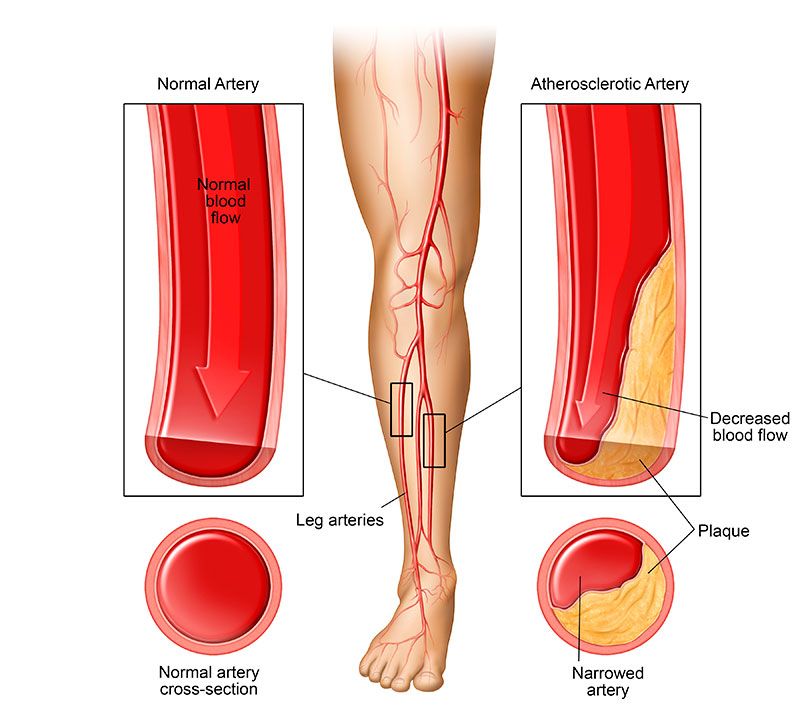 Illustrated leg with highlighted arteries showing the difference between a normal artery and atherosclerotic artery
