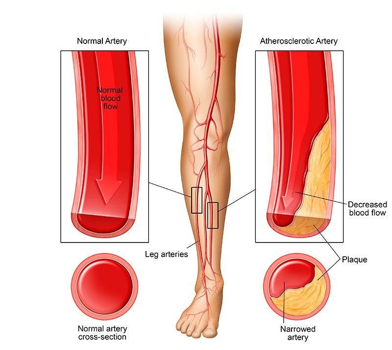 Cross Section Diagram of Artery in Normal and Altherosclerotic Condition