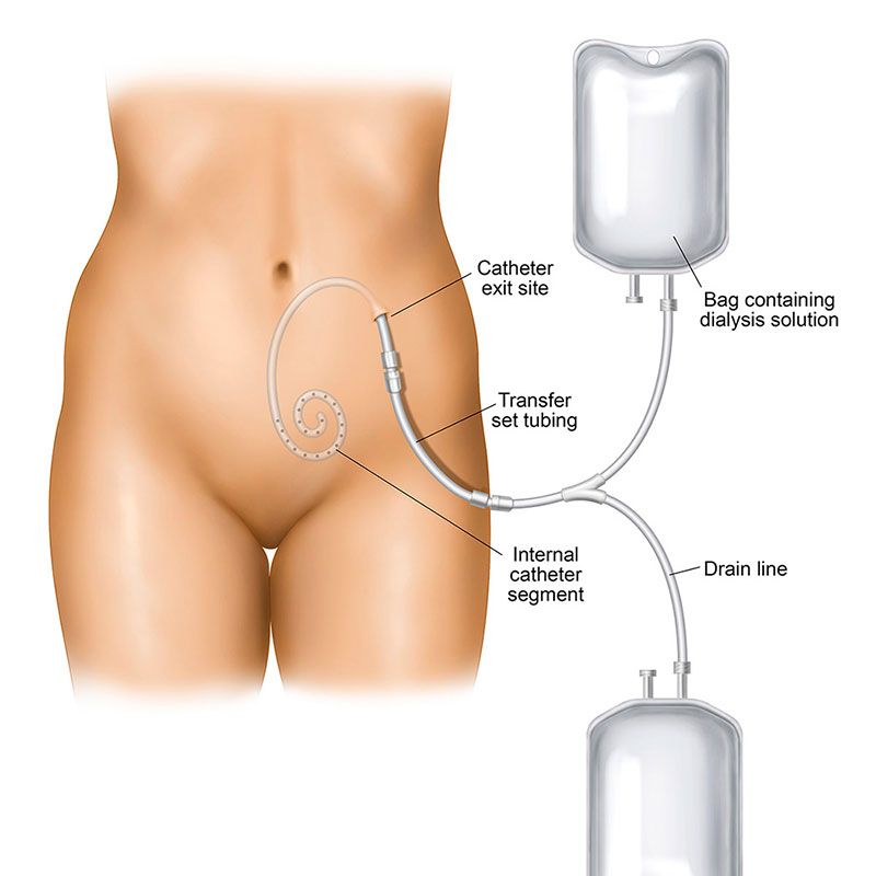 Peritoneal Dialysis Catheter Illustration