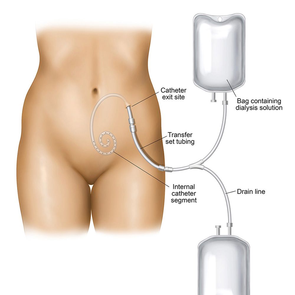 Peritoneal Dialysis Catheter