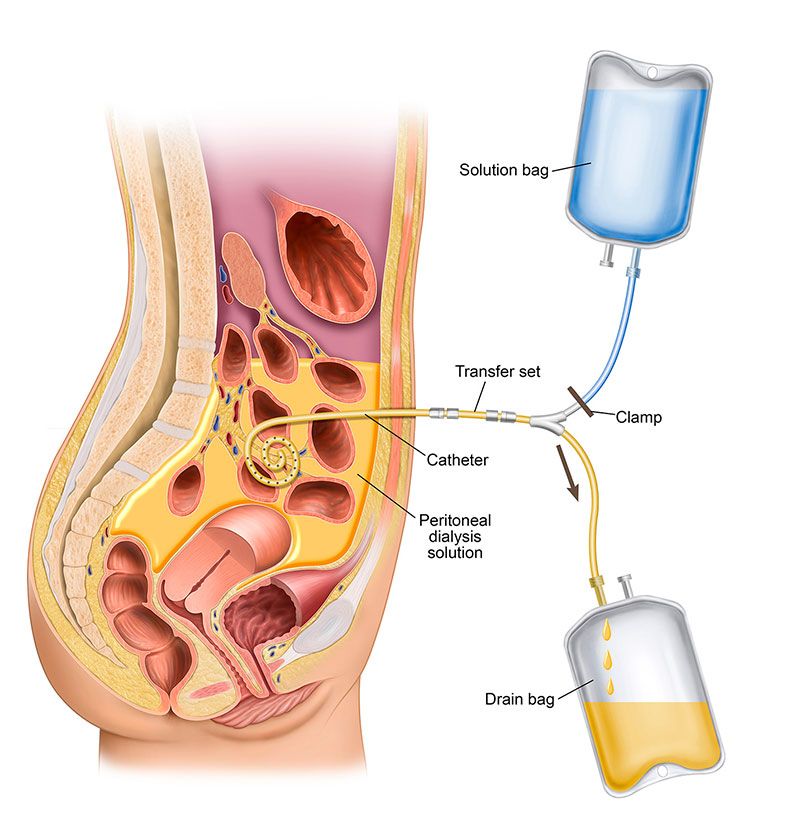 Peritoneal Dialysis Cycle Image