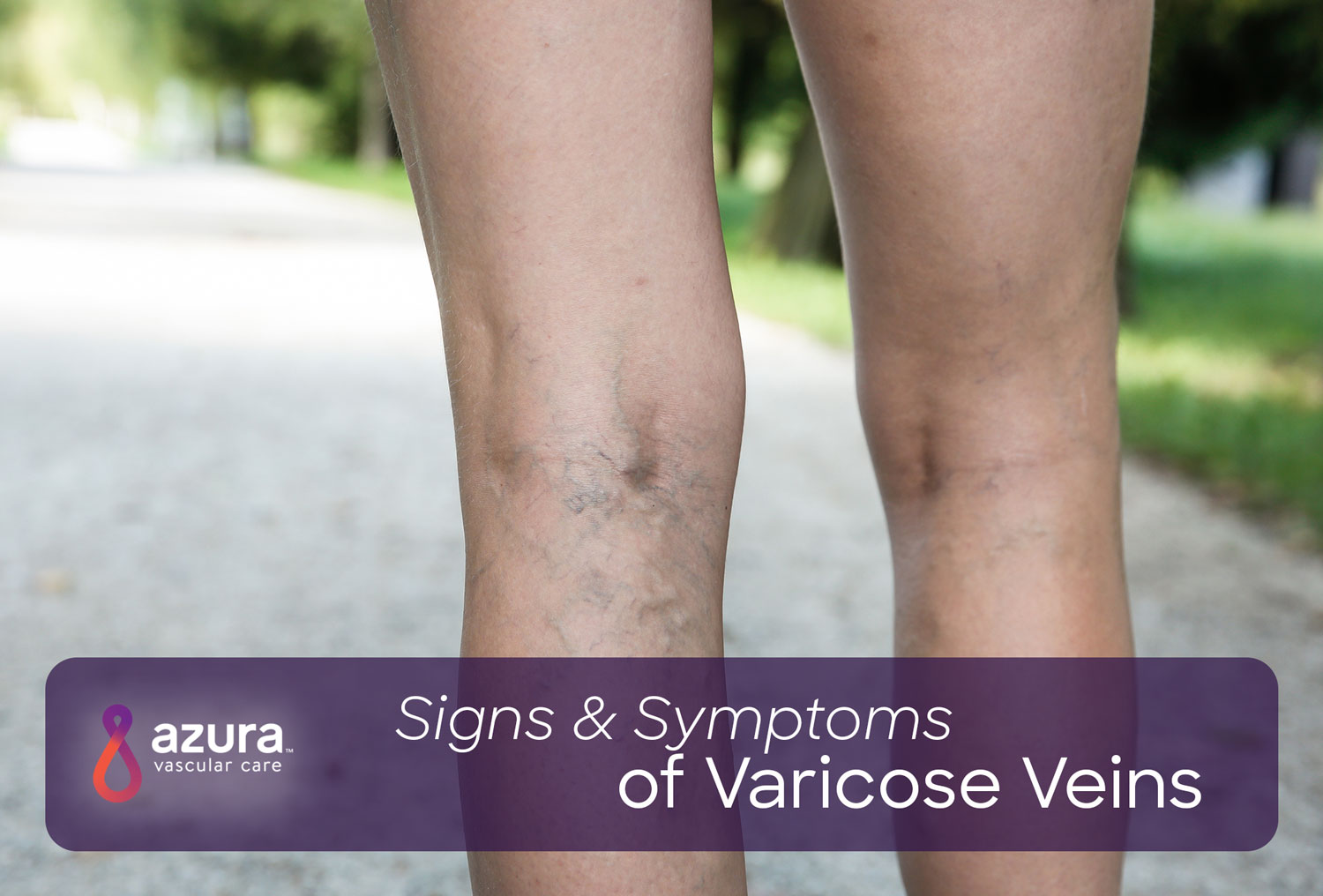 varicose spots photo