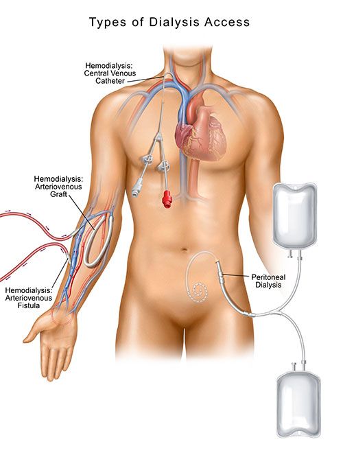Types of Dialysis Access Illustration