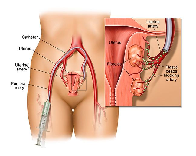 Uterine Fibroid Embolization Procedure Illustration