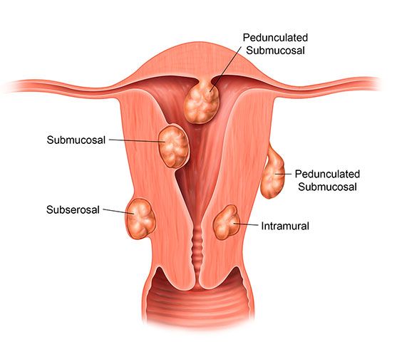 Types of Uterine Fibroids Illustration
