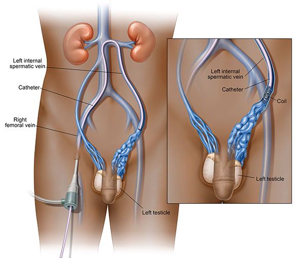 varicocele embolization diagram