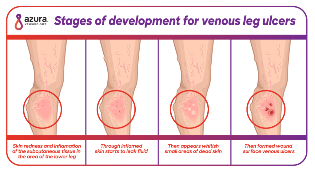 Stages of Developement for Venous Leg Ulcers