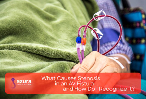 What Causes Stenosis in an AV Fistula and How Do I Recognize It main image