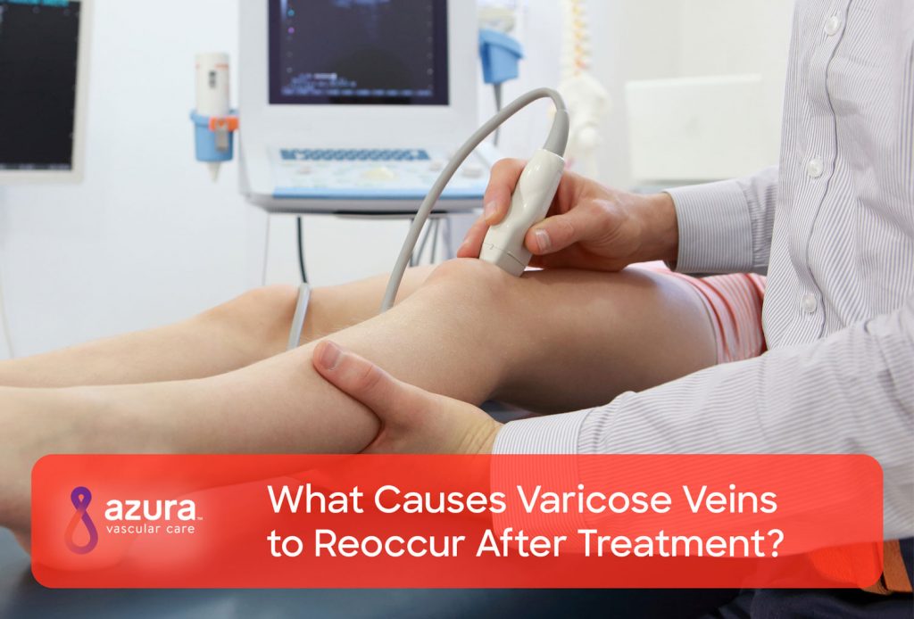 What Causes Varicose Veins to Reoccur After Treatment? main image