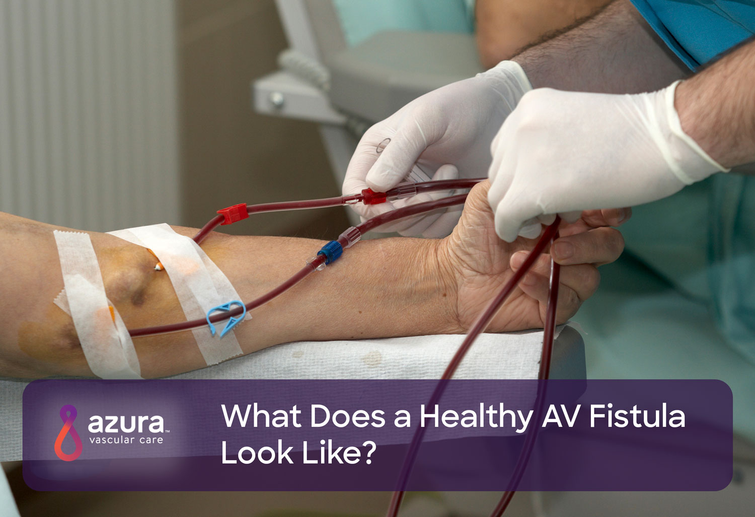 What Does a Healthy AV Fistula Look Like? | Azura Vascular Care