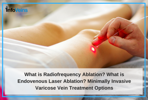 What Is Radiofrequency Ablation and Endovenous Laser Ablation? Other Treatment Options For Varicose Vein