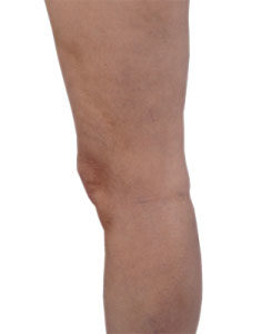 Picture of Leg After Varicose Vein Treatment