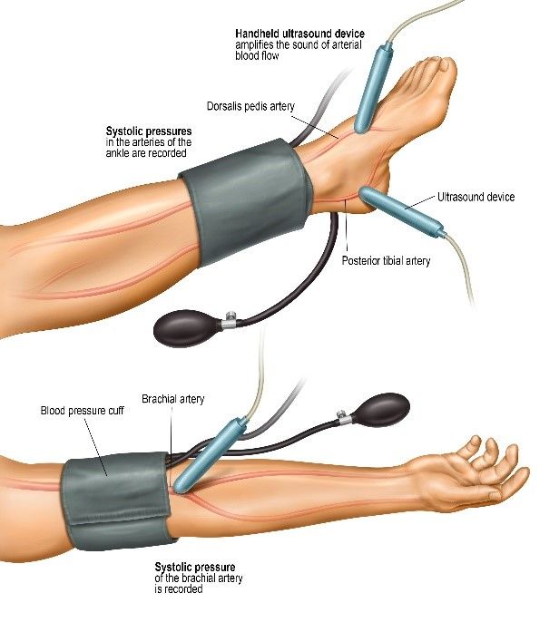 Ankle Brachial Index Illustration