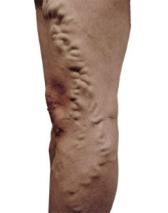 Picture of Leg Before Varicose Vein Treatment