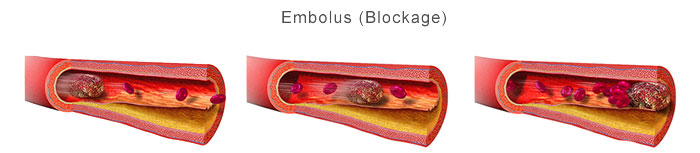 PAD Treatment Options: What is an Atherectomy?