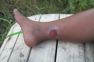 A photo of a leg ulcer