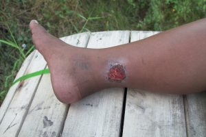 Symptoms and Complications of Chronic Venous Insufficiency