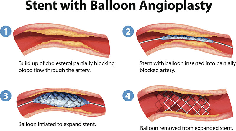 Stent With Balloon Angioplasty Illustration