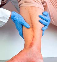bypass graft surgery leg scar