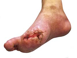 Non Healing Diabetic Foot Ulcer Image