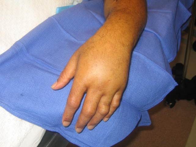 swollen hand from fistula