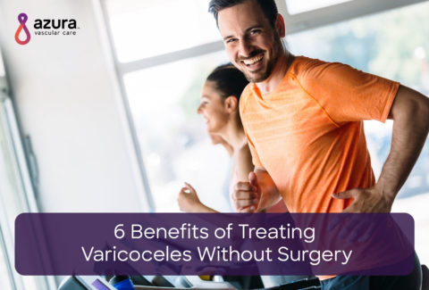 treating varicocele without surgery main image