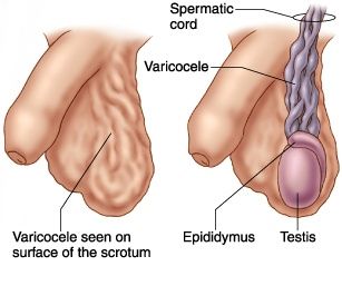 varicocele illustration