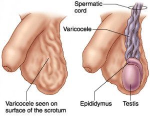 Varicocel: vene varicoase ale scrotului și ale cordului spermatic