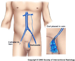 Varicocele Catheter Illustration