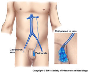 Treat Varicocele Infertility without Surgery